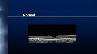 Vitreoretinal interface [upl. by Arundell]