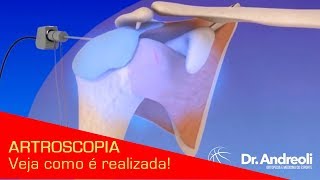 Artroscopia confira como é feita a cirurgia [upl. by Nennerb]