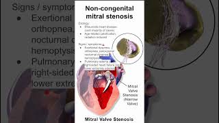 Mitral stenosis in adults [upl. by Burford]