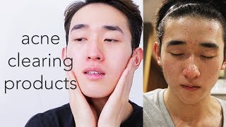 HOW TO TREAT BREAKOUTS FAST  TOP Products [upl. by Samson163]