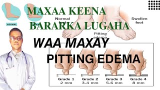 PITTING EDEMA  MAXAA KEENA BARARKA LUGAHA SIDA LOO DAAWEEYO [upl. by Tirb]