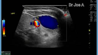 Internal jugular vein dilation phlebectasia bilateral  ultrasound and color Doppler video [upl. by Trinia]