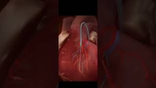 PTCA Procedure  Heart blockage  Cardiology  Prevention Heart Attack [upl. by Huskamp470]