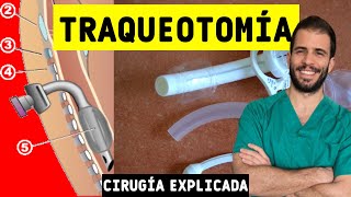 ⚠️ TRAQUEOTOMÍA ¿Cómo es la cirugía Riesgos y complicaciones ✅ [upl. by Ledua]