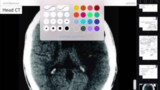 Neuropathology [upl. by Annaeerb]