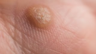 how to get rid of warts on fingers in a day [upl. by Anaiek]