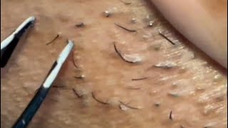 INGROWN HAIR REMOVAL 37  2022 a little suprise pluck 😷 [upl. by Hairem269]