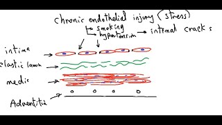 Systemic pathology 10  CVS  atherosclerosis  DRSAMEH GHAZY [upl. by Rawdin]