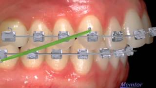 tractions intermaxillaires classe II [upl. by Onitsirc866]