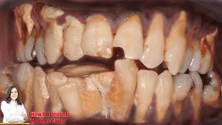 Tartar Teeth Removal  Very heavy Tartar Removal  teeth cleaning  dental cleaning [upl. by Onivla]