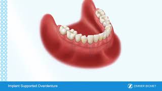 Implant Supported Overdenture [upl. by Nivlen]