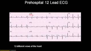 1215 Lead ECG The 12 Leads [upl. by Niram584]