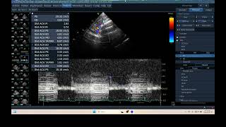 IQ 298 TCD BRAIN ULTRASOUND ECHOPAC ANALYSIS 2 [upl. by Nitsed]