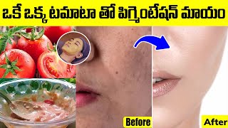 Dr Jyothsna  Natural Tip for Dark Spots on Face  Get Rid of Pigmentation  iDream Health Talks [upl. by Bates]