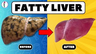 Strictly Avoid these 5 Foods if you have Fatty Liver  Fatty liver treatment  liver disease [upl. by Emor509]