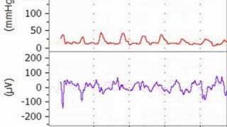 Lipid Reversal of Bupivacaine Toxicity [upl. by Finbar348]