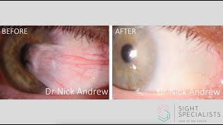 Pterygium surgery explained [upl. by Orecul626]