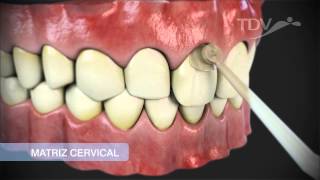 MATRIZ CERVICAL TDV  Restauraciones de Clase V [upl. by Nryhtak]