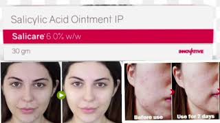 Salicare 60 ww Ointment Cream Scylic Acid Ointment IP [upl. by Romy]