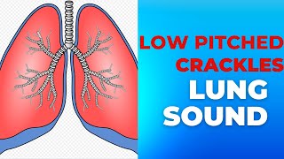 Low pitched Crackles Lung Sounds Collection EMPTprep [upl. by Pasho595]