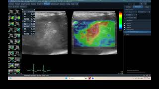 IQ 306 LIVER HEPATOMA ULTRASOUND ECHOPAC ANALYSIS ELASTOGRAPHY 2 [upl. by Schrick]