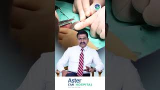 Treatment for Haemorrhoids  Dr Mahesh Chikkachannappa  Aster CMI Hospital [upl. by Nauqad885]