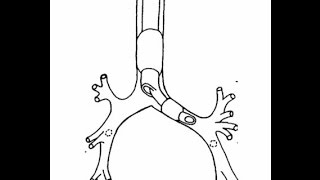 Endobronchial Blocker Placement  BAVLS [upl. by Yordan]