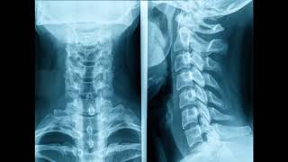 cervical spine intervertebral discs retropharyngeal fat stripe and posterior ororpharyngeal wall [upl. by Adaval495]