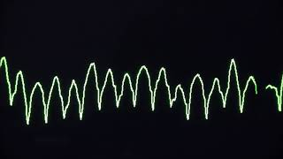 Cardiac arrest rhythms VF VT Asystole and PEA [upl. by Asital]