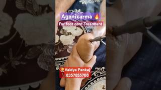 Foot corn Tretment Aganikarma ayurvedayoutubevideopanchakarmashortstrendingfootcornremoval [upl. by Ahseenyt]