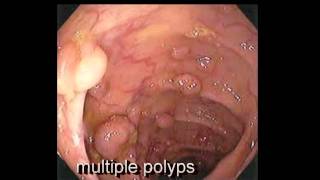 Colonoscopy FollowUp of Colon Polyp  Los Angeles Colonoscopy [upl. by Hgierb]