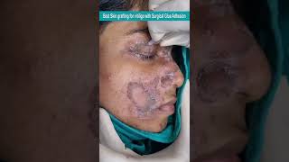 Best Skin grafting for vitiligo with Surgical Glue Adhesion Contact 9700020802 [upl. by Anairda]