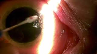 Slit lamp removal of corneal pannus by Steven G Safran MD [upl. by Gipps53]