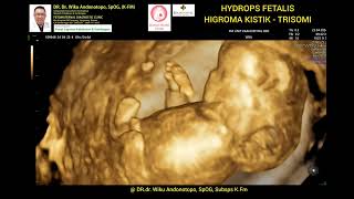 Hygroma Kistik  Hydrops Fetalis 12 Weeks  Trisomi [upl. by Aicemaj]