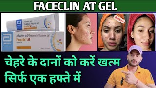 Faceclin at gel use in hindi चेहरे के दानों को करें ठीक [upl. by Shelbi326]