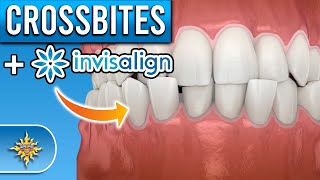 Can Invisalign Fix Crossbites [upl. by Nirrej108]