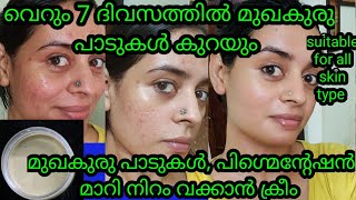 OMG Remove pimple marks and dark spots just 7 days Natural homemade cream for pimple marks darkspot [upl. by Fantasia145]