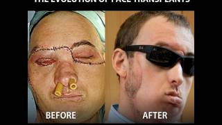 The Evolution of Face Transplants [upl. by German]