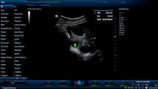 Dichorionic twins and two corpus luteum cysts Diagnostic ultrasound cases [upl. by Aderb960]