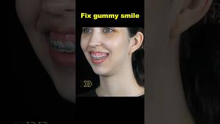 Fix gummy smile with braces braces orthodontist smile dentist [upl. by Mendes]