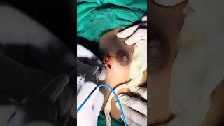 Excision of Lump Breast [upl. by Berk]