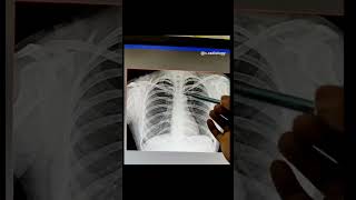 Anatomy of Chest Lungs x ray Radiology [upl. by Floss]