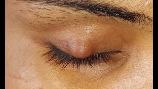 Chalazion Incision amp Curettage HD [upl. by Cudlip]