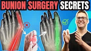 Bunion Surgery SECRETS amp FAST Recovery Bunionectomy vs Lapiplasty [upl. by Assirhc707]