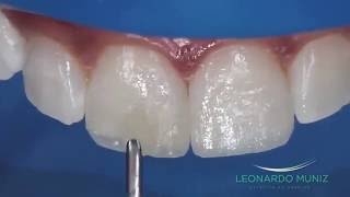 Aumento Incisal com Resinas Compostas  Leonardo Muniz [upl. by Pigeon543]