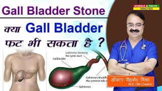 Gall bladder stone  क्या gall bladder फट भी सकता है   COMPLICATIONS OF GALL STONES [upl. by Rhea]