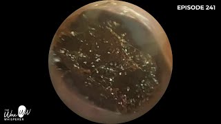 241  Ear Wax Removal in Stenotic Ear Canal using the WAXscope®️ [upl. by Lamarre]