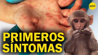 ¿Cuál es el primer signo de la viruela del mono Conoce los primeros síntomas [upl. by Marrin]