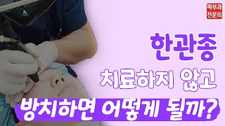 한관종 치료하지 않고 방치하면 어떻게 될까요 점점 더 커집니다😱 치료 미루지 마세요❗ [upl. by Licha805]