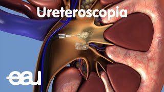 Tratamiento de cálculos renales y ureterales URS [upl. by Yrailih]